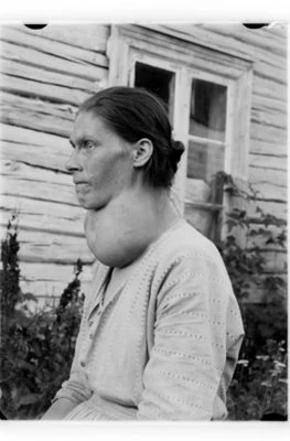 Most cases of goiter worldwide are caused by iodine deficiency.