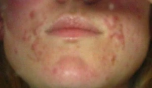 stefanis acne before