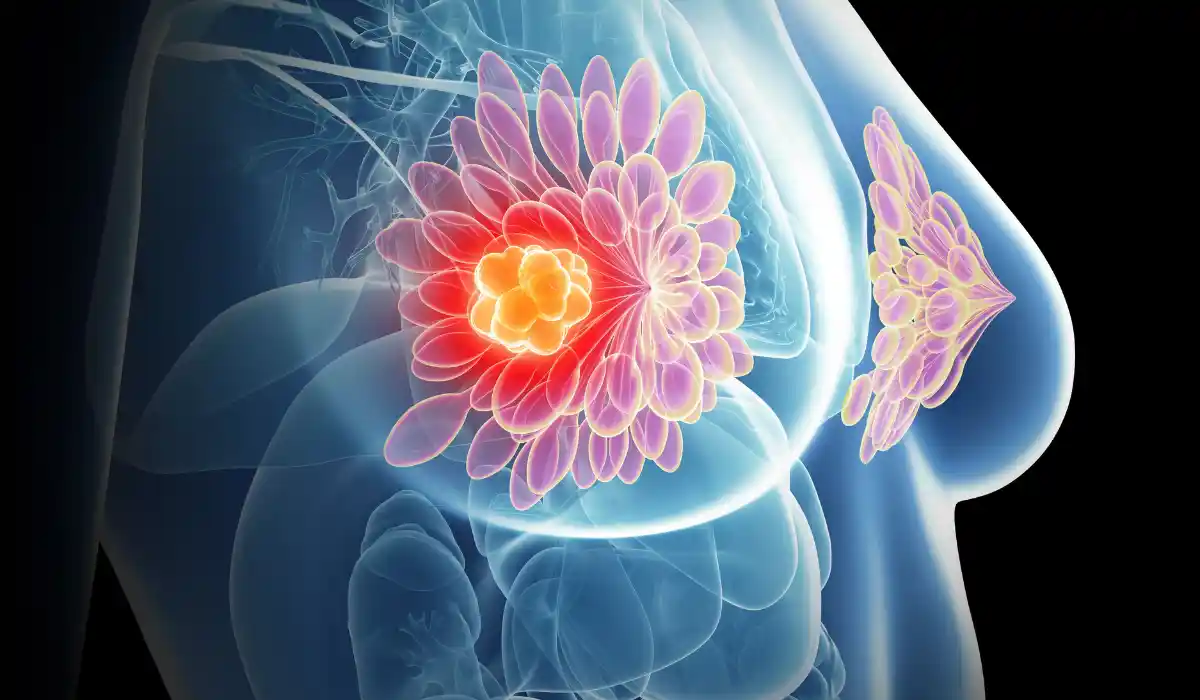 Early Breast Cancer: Treatments, Symptoms, and Survival