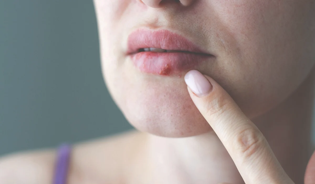 HPV vs Herpes: What Are the Key Differences, Symptoms, and Impact