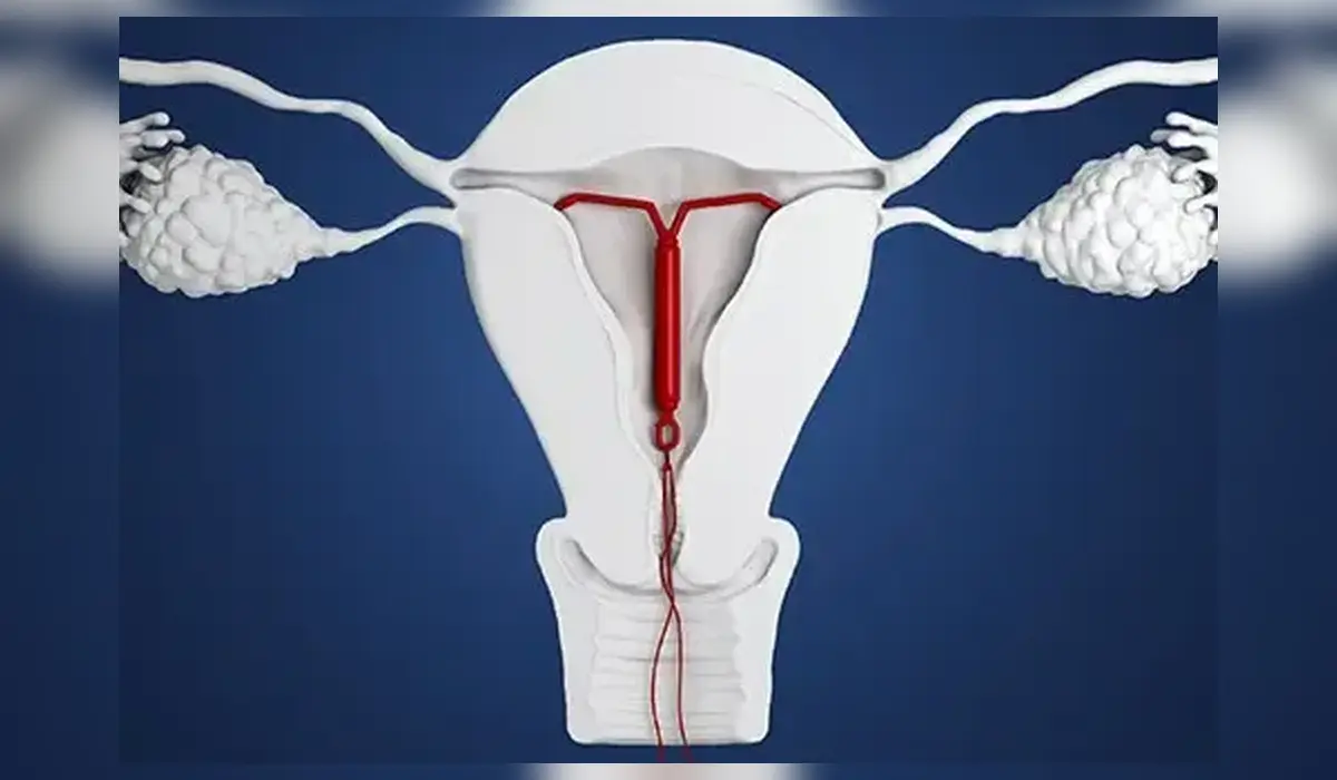 Does IUD Cause Weight Gain? Copper IUD vs Hormonal IUD