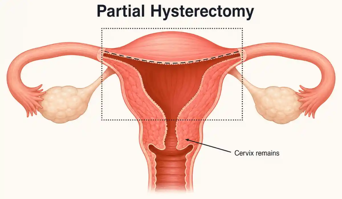 Partial Hysterectomy Guide: Surgery, Hormones And Recovery